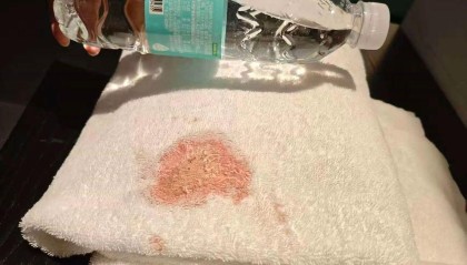 男子在成都一酒店使用浴巾发现大片血迹，担心染病要求赔偿，酒店质疑对方敲诈：客人可请机构上门取样送检