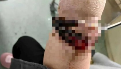 女子手镯10年没摘竟“长”进肉里！医生：再迟就保不住了