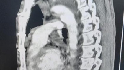 男子被12厘米钢丝刺入心脏，没想到3年前手术后形成的“保护层”救了他