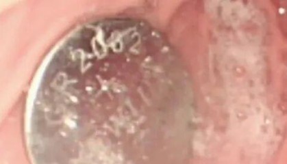 1岁半幼儿误吞电池致终身残疾