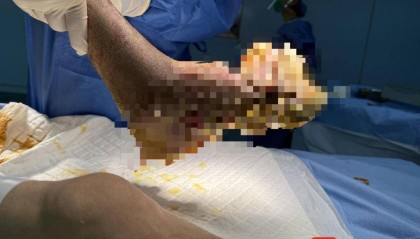 男子抠脚“抠”出满脚“菜花”，肛周也有少量，最终确诊HPV